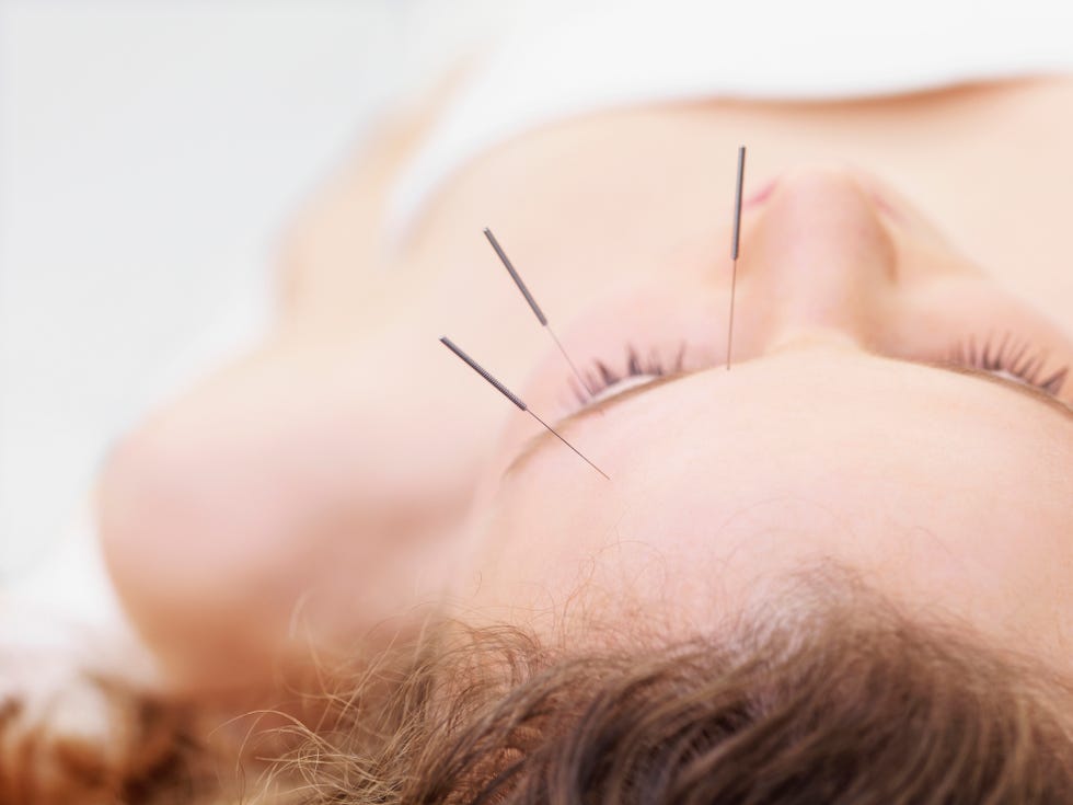 woman-receiving-acupuncture-royalty-free-image-81897994-1547832511
